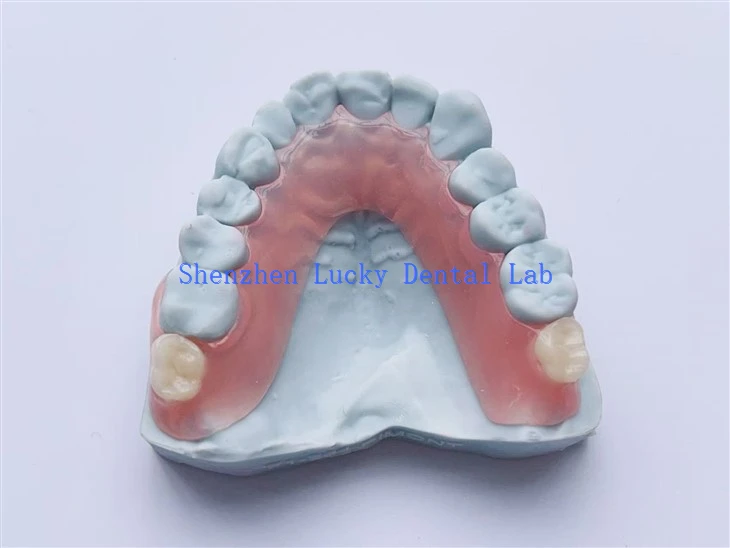 3D tipărit dentar parțial parțial flexibil laborator stomatologic