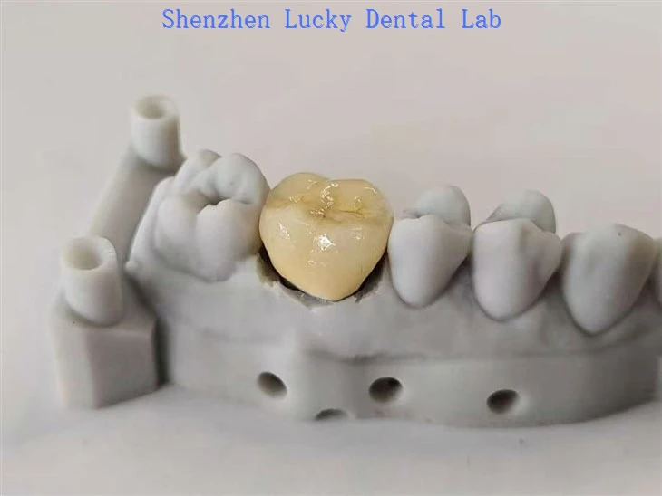 Aesthetic Dental PFM CoCr Crown Factory