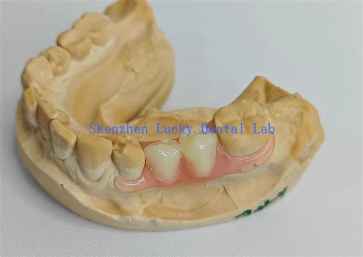 Valplast dentar estetic NESBIT DENTAL LAB