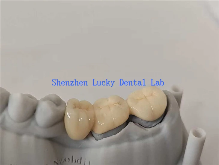 Dental PFM CO CR Bridge cu nucleu post