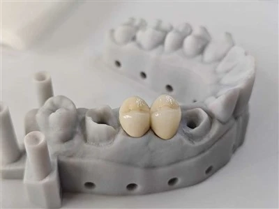 Podul estetic dentar PFM COCR